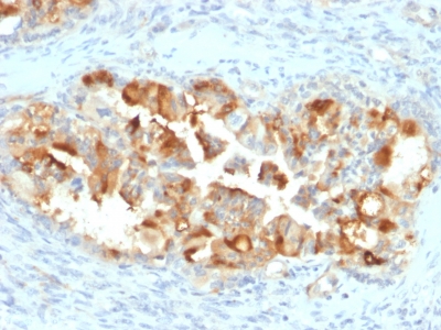 Formalin-fixed, paraffin-embedded human Endometrial Carcinoma stained with Mesothelin Mouse Monoclonal Antibody (MSLN/2131).
