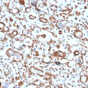 Formalin-fixed, paraffin-embedded human Renal Cell Carcinoma stained with Emerin Mouse Monoclonal Antibody (EMD/2167).