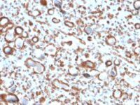 Formalin-fixed, paraffin-embedded human Renal Cell Carcinoma stained with Emerin Mouse Monoclonal Antibody (EMD/2167).