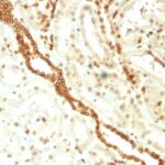 Formalin-fixed, paraffin-embedded human Renal Cell Carcinoma stained with Emerin Mouse Monoclonal Antibody (EMD/2168).