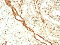 Formalin-fixed, paraffin-embedded human Renal Cell Carcinoma stained with Emerin Mouse Monoclonal Antibody (EMD/2168).