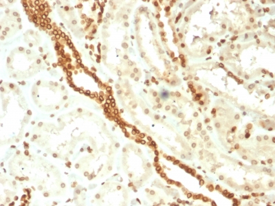 Formalin-fixed, paraffin-embedded human Renal Cell Carcinoma stained with Emerin Mouse Monoclonal Antibody (EMD/2168).