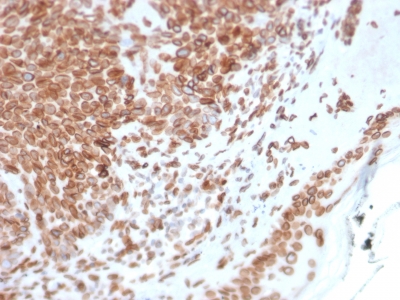 Formalin-fixed, paraffin-embedded human Basal Cell Carcinoma stained with Emerin Mouse Monoclonal Antibody (EMD/2168).