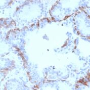 Formalin-fixed, paraffin-embedded human Prostate Carcinoma stained with Cytokeratin 6A (KRT6A) Mouse Monoclonal Antibody (KRT6A/2368).
