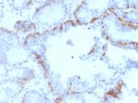 Formalin-fixed, paraffin-embedded human Prostate Carcinoma stained with Cytokeratin 6A (KRT6A) Mouse Monoclonal Antibody (KRT6A/2368).