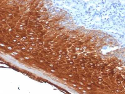 Formalin-fixed, paraffin-embedded human Basal Cell stained with Cytokeratin 6A (KRT6A) Mouse Monoclonal Antibody (KRT6A/2368).