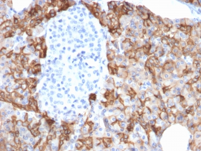 Formalin-fixed, paraffin-embedded human Pancreatic Carcinoma stained with TACSTD2 / TROP2 Mouse Monoclonal Antibody (TACSTD2/2152).