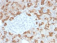 Formalin-fixed, paraffin-embeddedhuman PancreaticCarcinoma stained with TACSTD2 / TROP2Mouse Monoclonal Antibody (TACSTD2/2153).