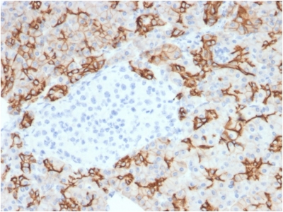 Formalin-fixed, paraffin-embeddedhuman PancreaticCarcinoma stained with TACSTD2 / TROP2Mouse Monoclonal Antibody (TACSTD2/2153).
