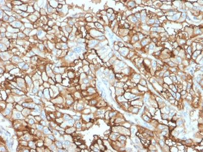 Formalin-fixed, paraffin-embedded Human Renal Cell Carcinoma stained with CD10 Mouse Monoclonal Antibody (MME/1870).