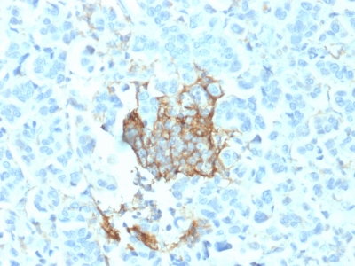 Formalin-fixed, paraffin-embedded human Breast Carcinoma stained with NGFR Mouse Monoclonal Antibody (NGFR/1964).