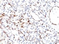 Formalin-fixed, paraffin-embedded human Renal Cell Carcinoma stained with PTEN Mouse Monoclonal Antibody (PTEN/2110).