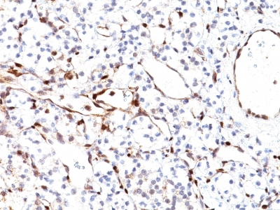 Formalin-fixed, paraffin-embedded human Renal Cell Carcinoma stained with PTEN Mouse Monoclonal Antibody (PTEN/2110).