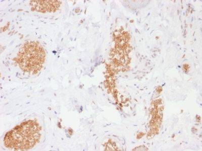 Formalin-fixed, paraffin-embedded human Bladder stained with GLUT-1 Mouse Monoclonal Antibody (GLUT1/2476).