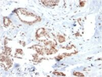 Formalin-fixed, paraffin-embedded human Breast Carcinoma stained with SOX4 Mouse Monoclonal Antibody (SOX4/2540).