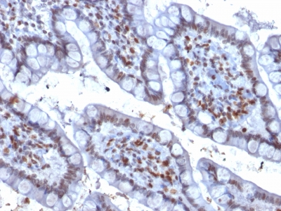 Formalin-fixed, paraffin-embedded human Colon Carcinoma stained with PU.1 Mouse Monoclonal Antibody (PU1/2146).