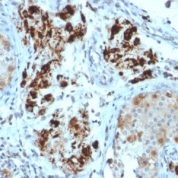 Formalin-fixed, paraffin-embedded human Testicular Carcinoma stained with StAR Mouse Monoclonal Antibody (STAR/2154).