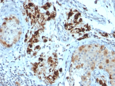 Formalin-fixed, paraffin-embedded human Testicular Carcinoma stained with StAR Mouse Monoclonal Antibody (STAR/2154).
