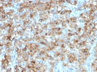 Formalin-fixed, paraffin-embedded human Testicular Carcinoma stained with StAR Mouse Monoclonal Antibody (STAR/2154).