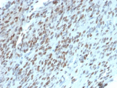 Formalin-fixed, paraffin-embedded Human GIST stained with TLE1 Mouse Monoclonal Antibody (TLE1/2062).