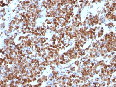 Formalin-fixed, paraffin-embedded human Melanoma stained with Vimentin Mouse Monoclonal Antibody (VM452).