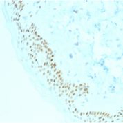 Formalin-fixed, paraffin-embedded human Basal Cell Carcinoma stained with p63 Mouse Monoclonal Antibody (TP63/2428).
