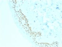 Formalin-fixed, paraffin-embedded human Basal Cell Carcinoma stained with p63 Mouse Monoclonal Antibody (TP63/2428).