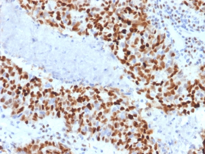 Formalin-fixed, paraffin-embedded Human Colon Carcinoma stained with Cyclin E Mouse Monoclonal Antibody (CCNE1/2460).