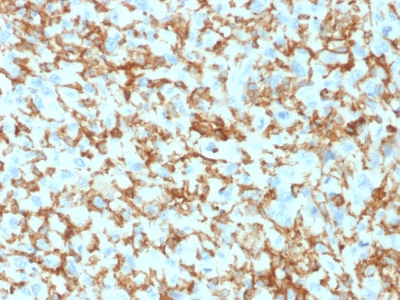 Formalin-fixed, paraffin-embedded human Histiocytoma stained with CD163 Mouse Monoclonal Antibody (M130/1210).