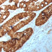 Anti-M+R SingleStep Poly HRP conjugated secondary staining of human FFPE rectal tissue (primary is anti-EpCAM antibody clone 2041).