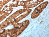 Anti-M+R SingleStep Poly HRP conjugated secondary staining of human FFPE rectal tissue (primary is anti-EpCAM antibody clone 2041).