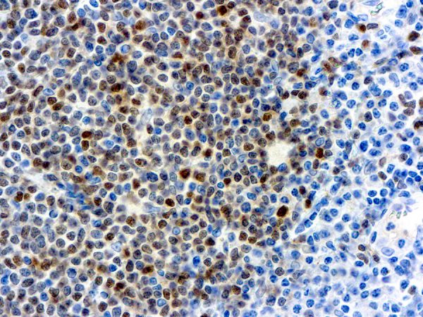 Immunohistochemical staining of Cyclin D1  of human FFPE tissue followed by incubation with HRP labeled secondary and development with DAB substrate.
