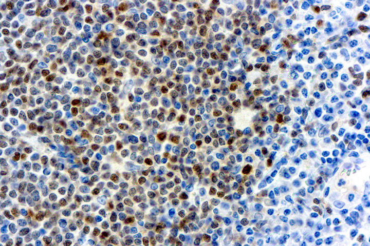 Immunohistochemical staining of Cyclin D1  of human FFPE tissue followed by incubation with HRP labeled secondary and development with DAB substrate.