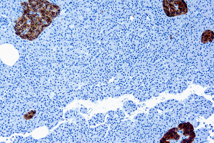 Immunohistochemical staining of Chromogranin A  of human FFPE tissue followed by incubation with HRP labeled secondary and development with DAB substrate.