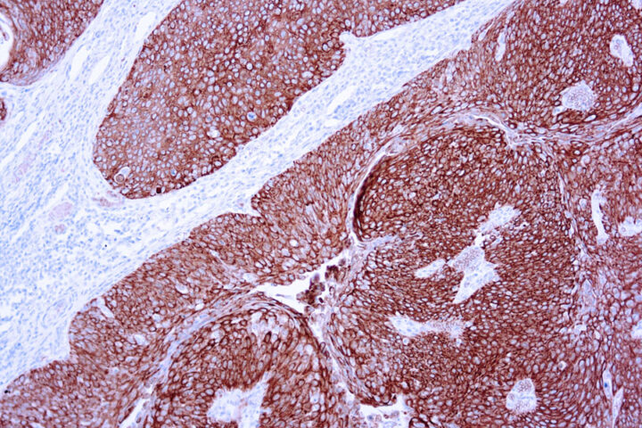 Immunohistochemical staining of Cytokeratin 10  of human FFPE tissue followed by incubation with HRP labeled secondary and development with DAB substrate.