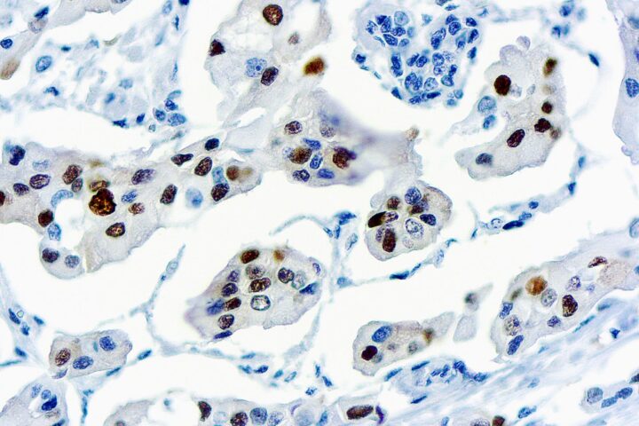 Immunohistochemical staining of Cyclin D1  of human FFPE tissue followed by incubation with HRP labeled secondary and development with DAB substrate.