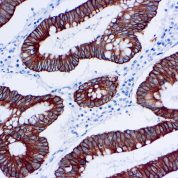 Immunohistochemical staining of Cytokeratin 18  of human FFPE tissue followed by incubation with HRP labeled secondary and development with DAB substrate.