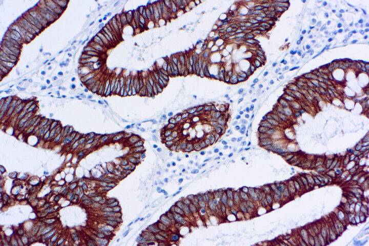 Immunohistochemical staining of Cytokeratin 18  of human FFPE tissue followed by incubation with HRP labeled secondary and development with DAB substrate.