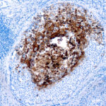 Immunohistochemical staining of Cytokeratin 17  of human FFPE tissue followed by incubation with HRP labeled secondary and development with DAB substrate.