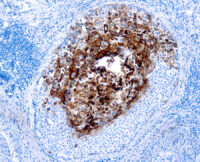 Immunohistochemical staining of Cytokeratin 17  of human FFPE tissue followed by incubation with HRP labeled secondary and development with DAB substrate.