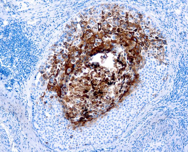 Immunohistochemical staining of Cytokeratin 17  of human FFPE tissue followed by incubation with HRP labeled secondary and development with DAB substrate.
