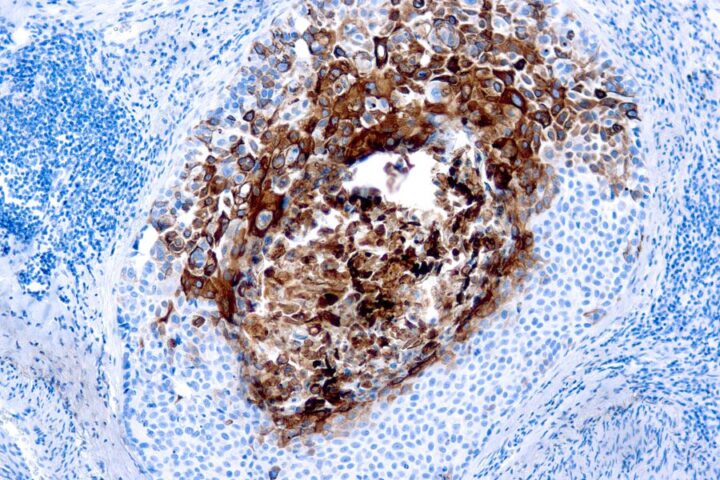 Immunohistochemical staining of Cytokeratin 17  of human FFPE tissue followed by incubation with HRP labeled secondary and development with DAB substrate.