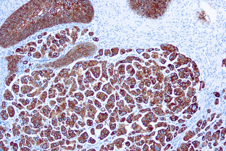 Immunohistochemical staining of Cytokeratin 7  of human FFPE tissue followed by incubation with HRP labeled secondary and development with DAB substrate.