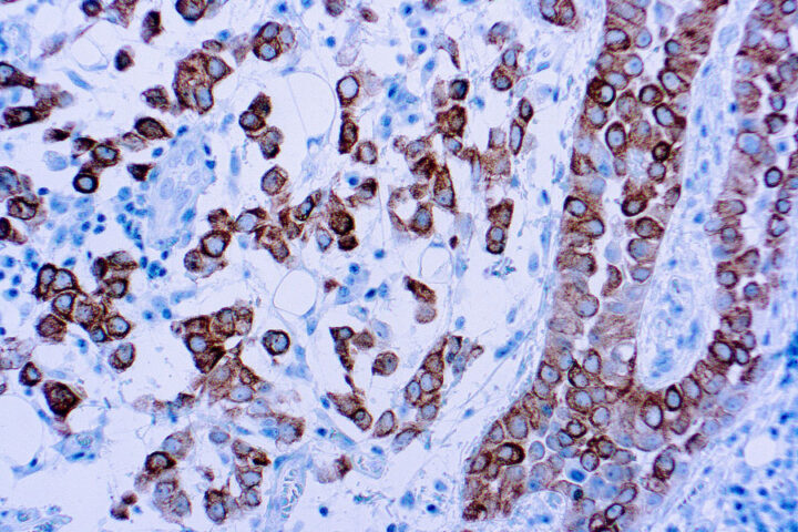 Immunohistochemical staining of Cytokeratin 5  of human FFPE tissue followed by incubation with HRP labeled secondary and development with DAB substrate.