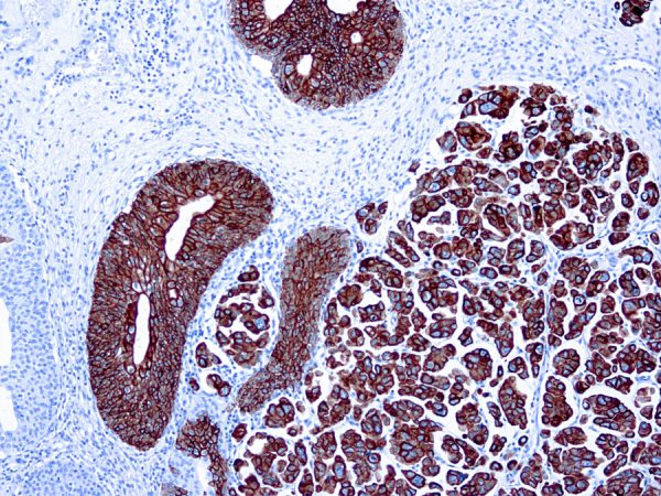 Immunohistochemical staining of Cytokeratin 7  of human FFPE tissue followed by incubation with HRP labeled secondary and development with DAB substrate.