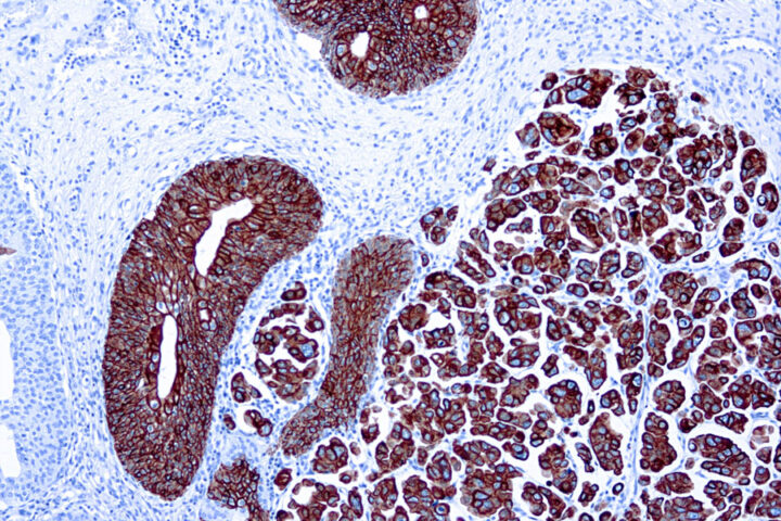 Immunohistochemical staining of Cytokeratin 7  of human FFPE tissue followed by incubation with HRP labeled secondary and development with DAB substrate.