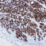 Immunohistochemical staining of Cytokeratin 19  of human FFPE tissue followed by incubation with HRP labeled secondary and development with DAB substrate.