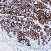 Immunohistochemical staining of Cytokeratin 19  of human FFPE tissue followed by incubation with HRP labeled secondary and development with DAB substrate.