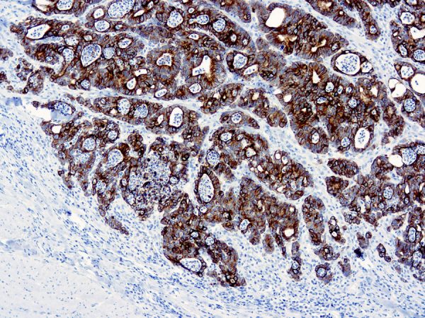 Immunohistochemical staining of Cytokeratin 19  of human FFPE tissue followed by incubation with HRP labeled secondary and development with DAB substrate.