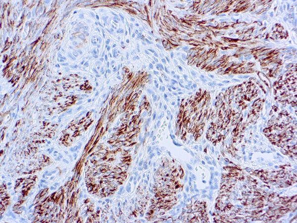 Immunohistochemical staining of Desmin  of human FFPE tissue followed by incubation with HRP labeled secondary and development with DAB substrate.
